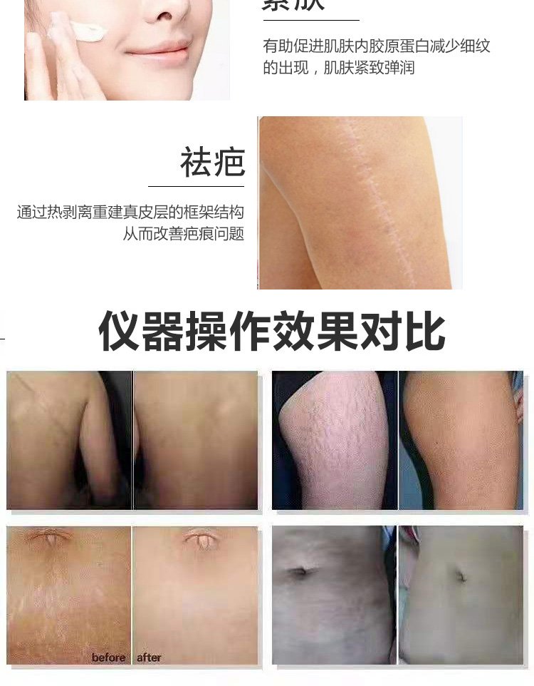 点阵激光仪器欧洲之星眼周面部皮肤管理去痘坑抗老嫩肤_2dc5f61f.jpg