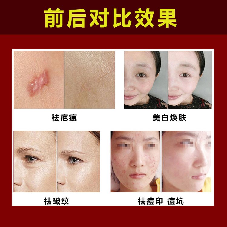 欧洲之星fotona 4D Pro 收缩毛孔点阵激光淡斑嫩肤_b06bf35b.jpg