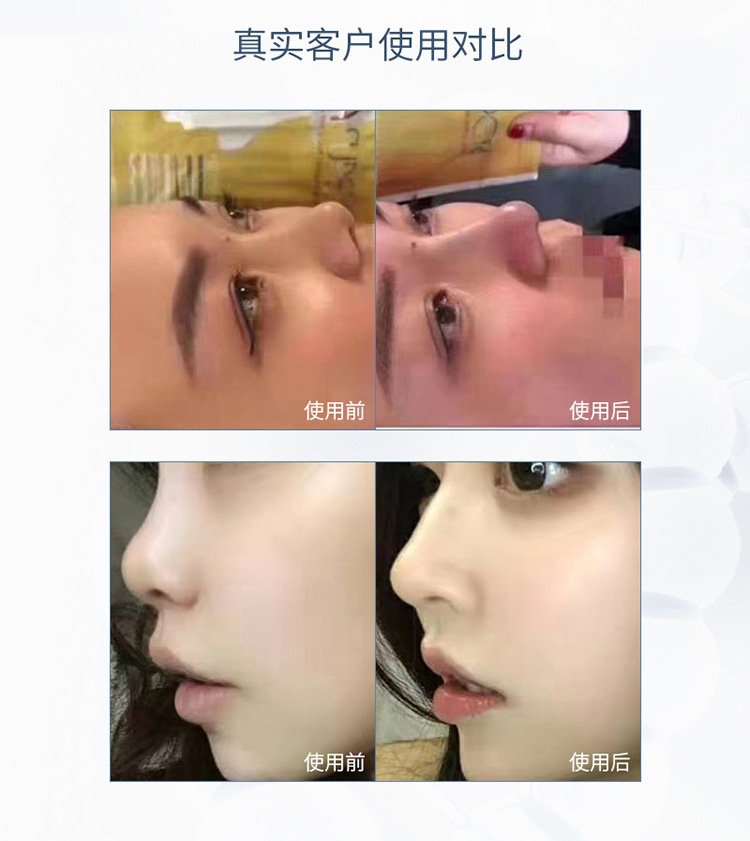 微球肋骨鼻 胶原蛋白 少女面部精雕 下巴五官塑形 美容院货源工厂_e7e6cc56.jpg